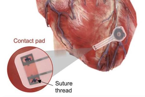 تولید نخستین ضربان ساز مصنوعی قلب كه در بدن حل می شود